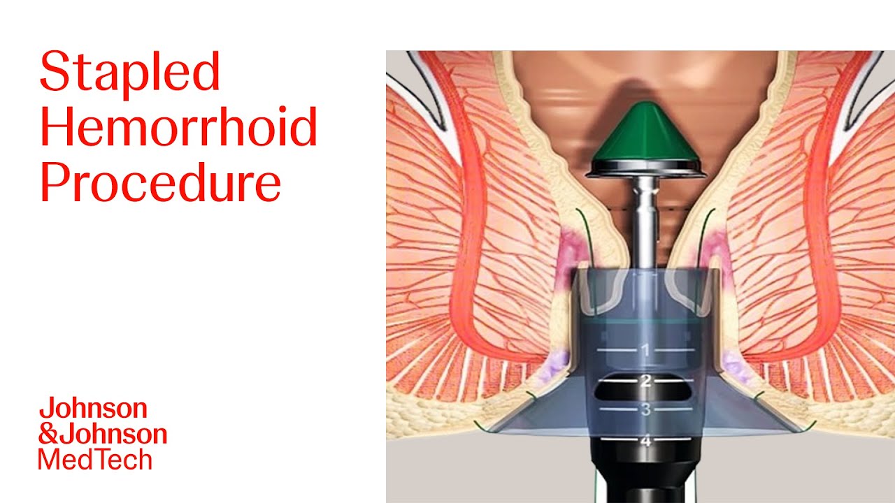 PPH Procedure Animation | Stapled Hemorrhoid Surgery