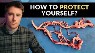 Amyloid Clots Found in EVERY SINGLE PERSON: Brand New Study