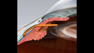 Glaucoma microtube procedure