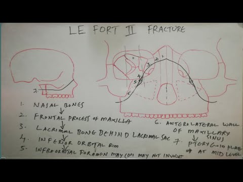 LE FORT-II FRACTURE LINE