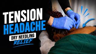 This Dry Needling Treatment Hit the Exact Spot Causing Her Headache