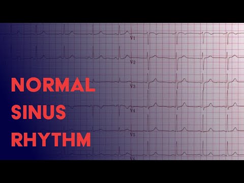 Normal Sinus Rhythm -  EKG (ECG) Interpretation