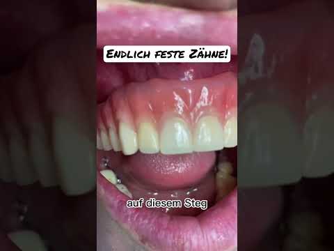 Feste ZÄHNE! #zahnimplantate #zahnersatz #festezähne #implantat #zahnarzt #prothese #schönezähne