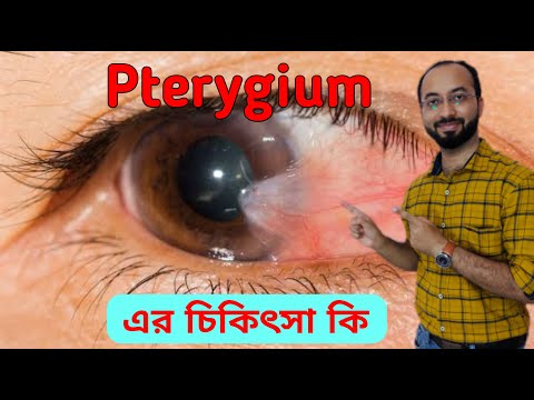 What is Pterygium | How to Get Rid of Pterygium | Pterygium Treatment @DrTasnimJara