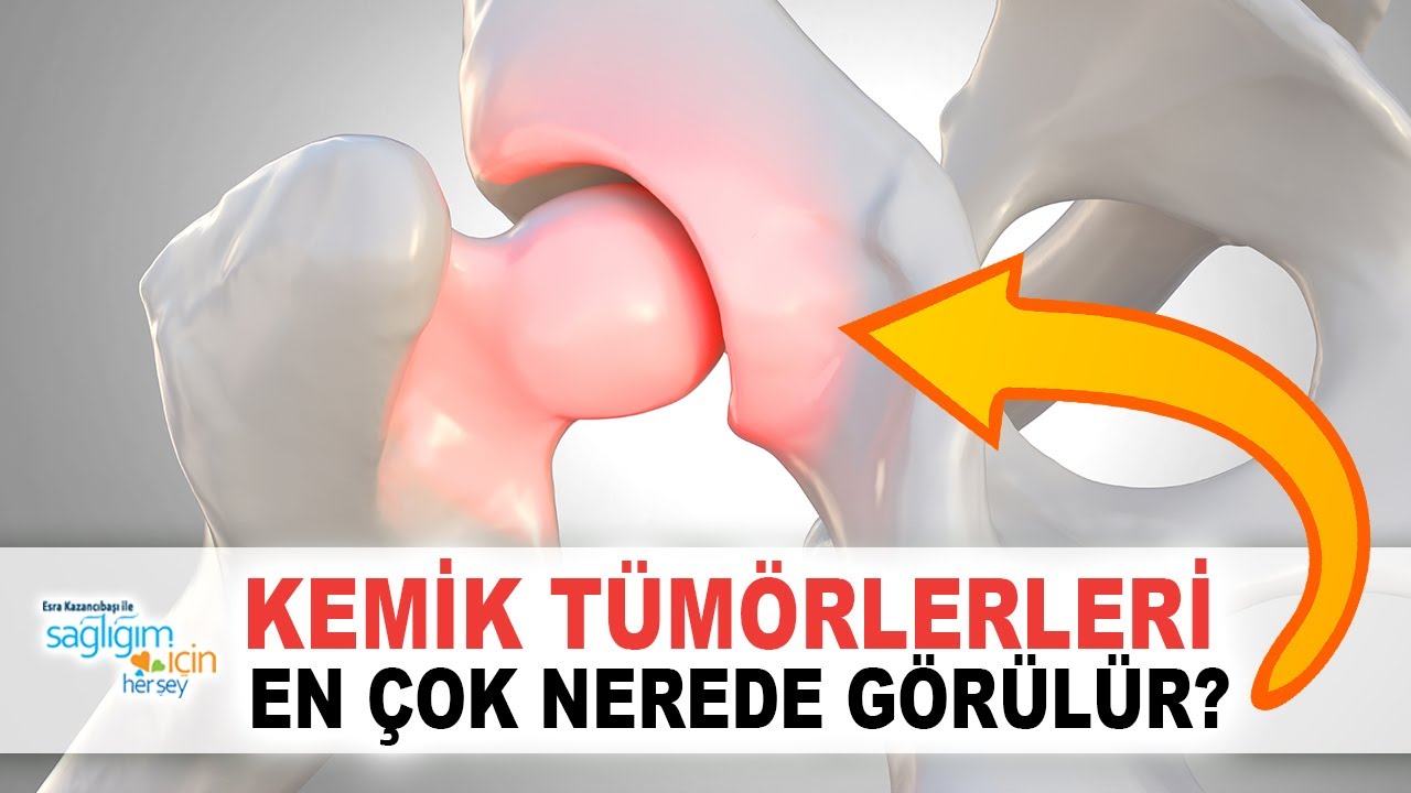Hangi Ağrılar Kemik Tümörlerinin Habercisi Olabilir?
