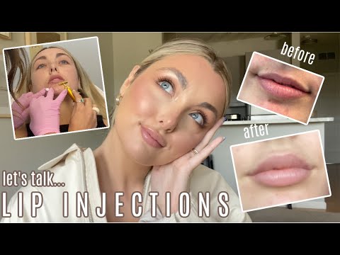 FIRST TIME GETTING LIP INJECTIONS | cost, pain, everything you need to know