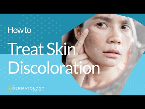 How to Treat Skin Discoloration