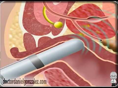 dieta post operatoria prostata