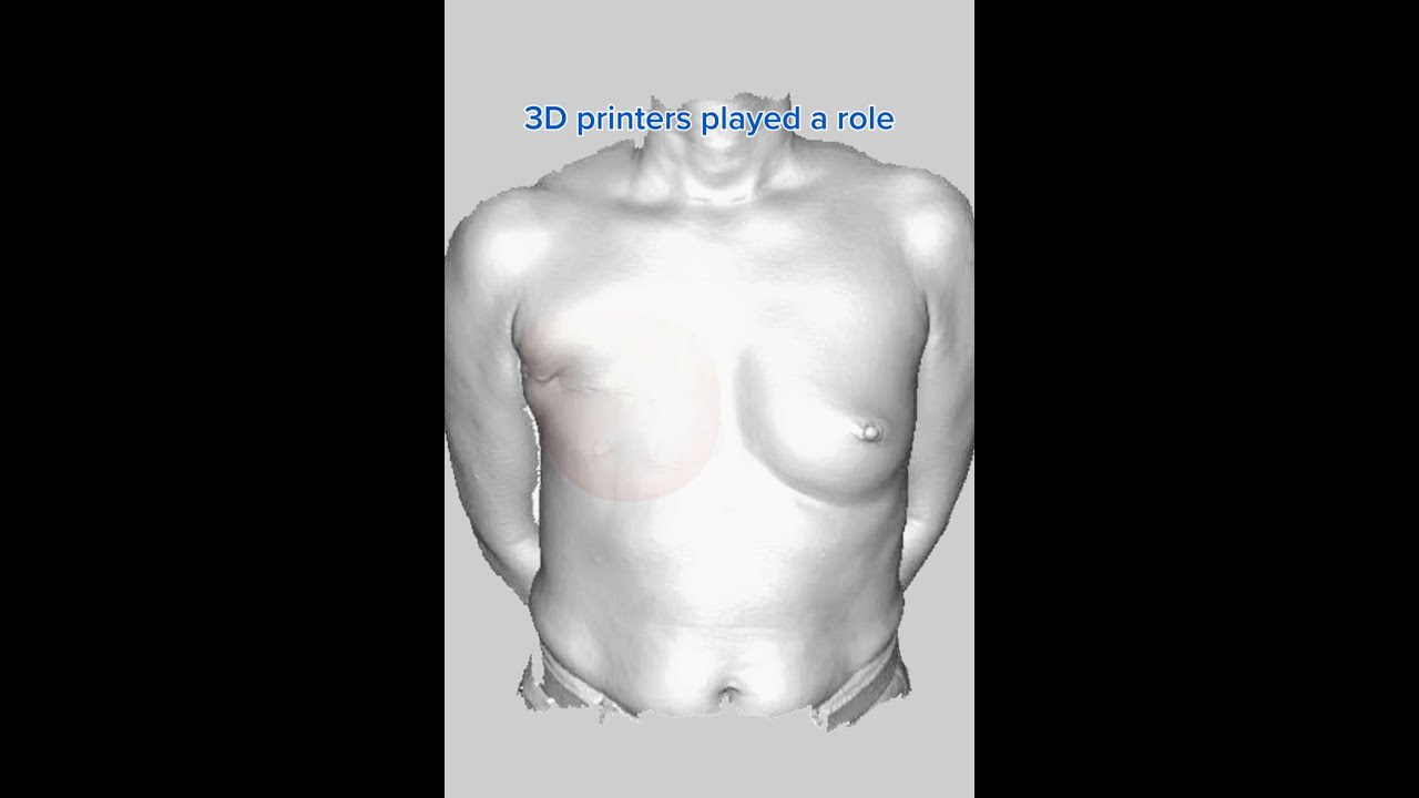 Revolutionary 3D-Customized Breast Prosthesis: Boosting Confidence After Mastectomy