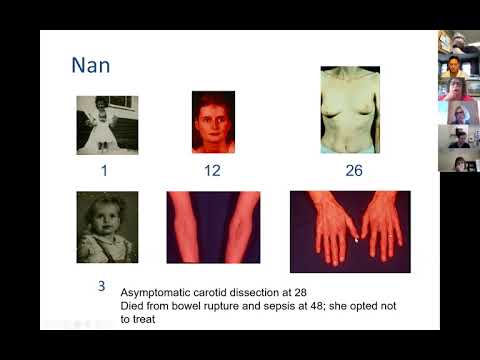 EDS ECHO Clinicians North America (CLN4A), Session 2