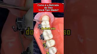 COMO É A RETIRADA DO DENTE SISO #saude #saudavel #dente #SISO