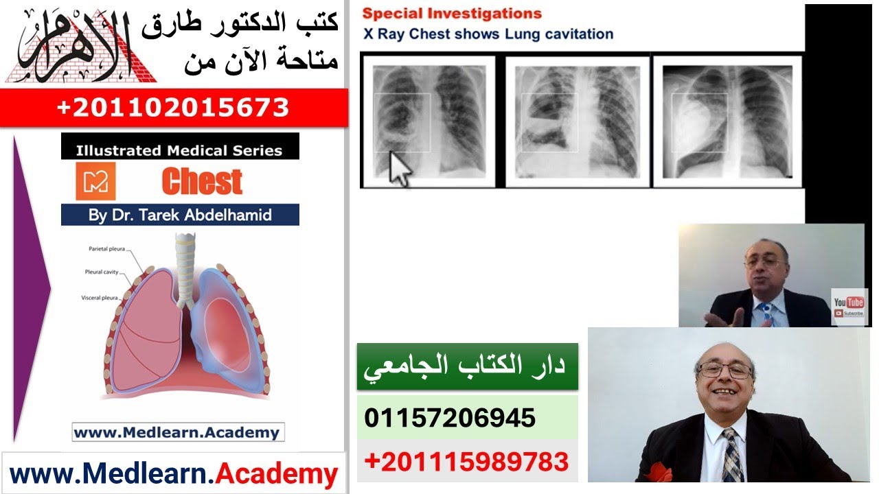 Lung abscess  #cme #internal_medicine #medical #usmle #محاضرات_باطنة