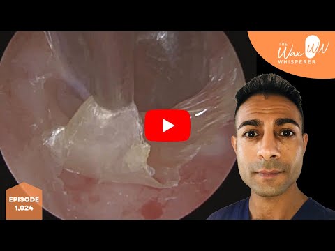 1,024 - Keratosis Obturans Thick Dead Skin Peel