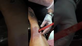Pulling out wound packing after surgery