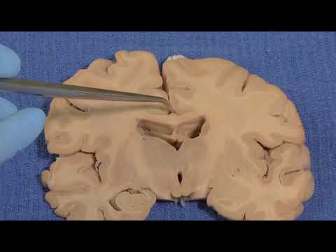 Limbic  Neuroanatomy Video Lab   Brain Dissections