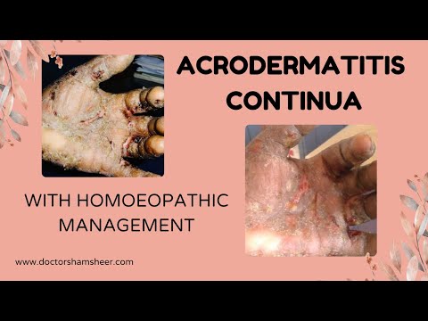 Acrodermatitis continua- ACD