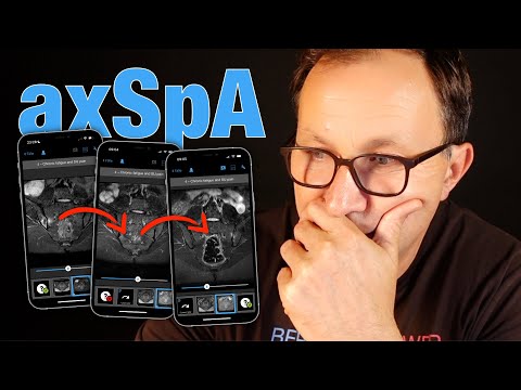 The course of AXIAL SPONDYLOARTHRITIS over 3 years as seen on MRI