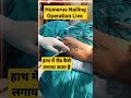 Humerus Nailing Operation Live हाथ में रॉड कैसे लगाया जात�