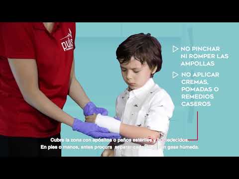 ¿Cómo tratar una quemadura?