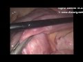 CONVERSION OF GASTRIC BYPASS (RYGB) TO ...