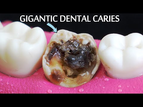 Restoration Of Massive Tooth Decay | Root Canal And Crown Process