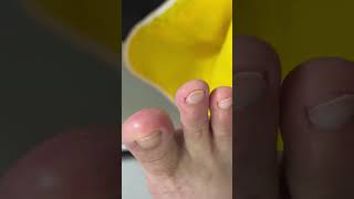 Ep_8183 Foot nail skin removal 👣 After watching the clip..I feel like I have to come see P'Uam 😄 ...
