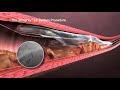Boston Scientific Coronary CTO System Overview