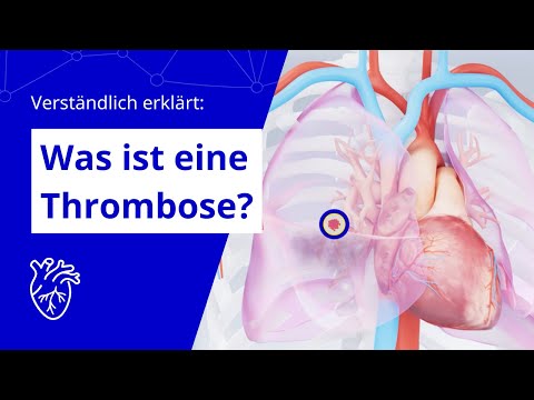 Explained in simple terms: What is thrombosis?
