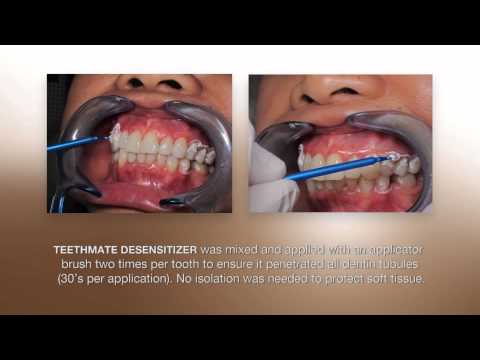 Десенситайзер TEETHMATE, TEETHMATE DESENSITIZER (Kuraray Noritake) - фото 3 - id-p2798480170