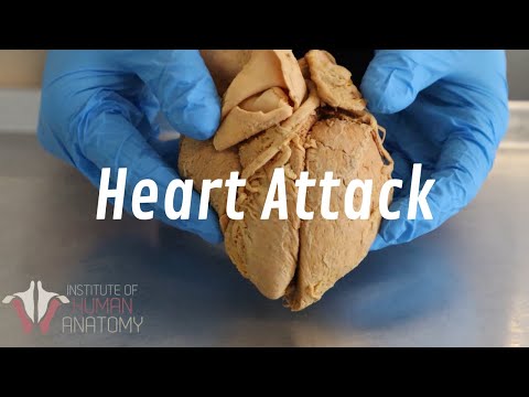What Happens During a Heart Attack | Anatomy of a Heart Attack