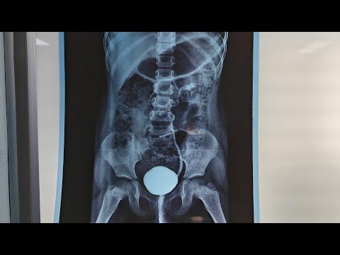 STING procedure; endoscopic treatment VUR in lower moiety duplication @Pediatric-Urologist