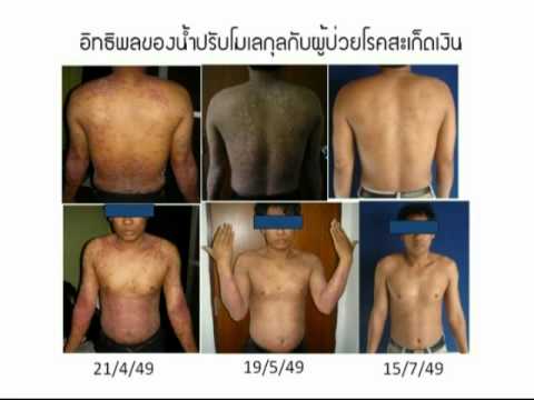อาการอาการภูมิแพ้ กลากผิวบนหลังของเธอ
