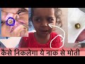 How to remove Nasal Foreign Body in Children | नाक से इतना बडा मोती कैसे नि