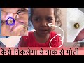 How To Remove Nasal Foreign Body In Children नाक से इतना बडा मोती �