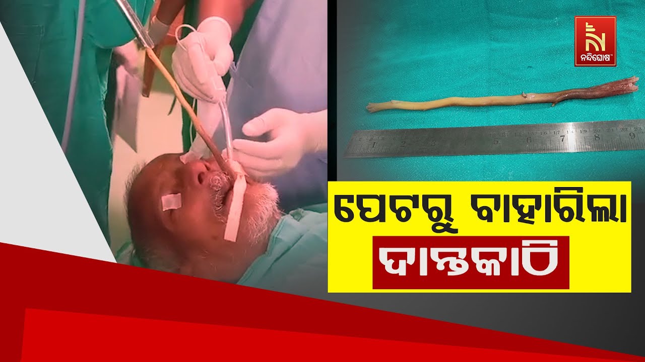 ଖାଦ୍ୟନଳୀରୁ ବାହାରିଲା ୯ ଇଂଚର ଦାନ୍ତକାଠି