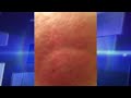 Skin Rash Leads to Shocking Diagnosis