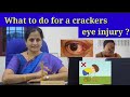 What to do if cracker💥 hits your Eye👁️?