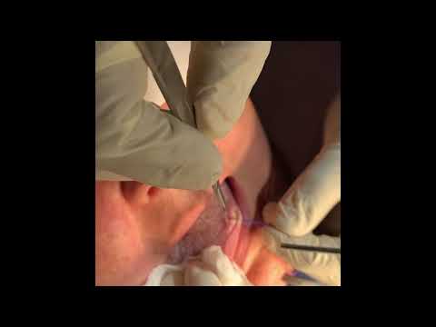 Excision Biopsy On The Lateral Border Of The Tongue For A Non Healing Ulcer