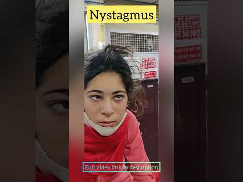 nystagmus seen in a patient I  horizontal jerky eye movements l central nystagmus #neurology #shorts