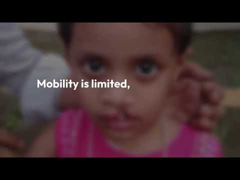 FREE OF COST CLEFT LIP PALATE SURGERY OPERATION