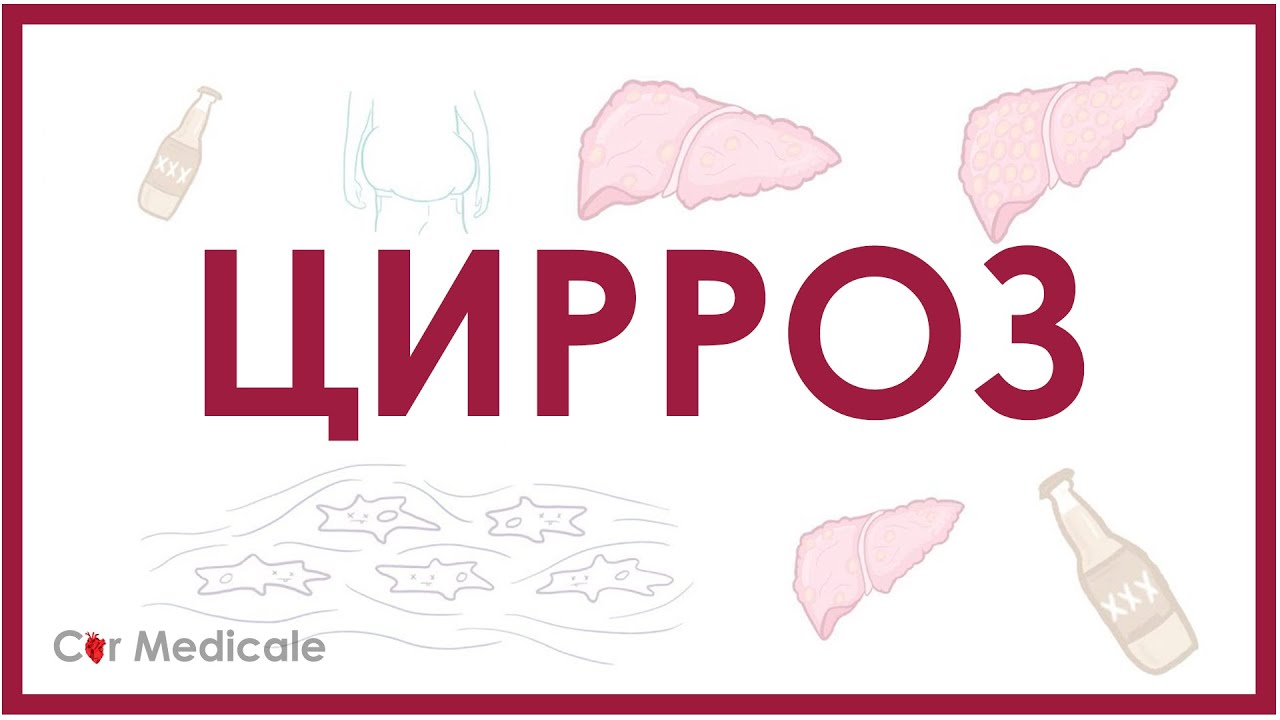 Цирроз печени - причины, патогенез, симптомы, осложнения