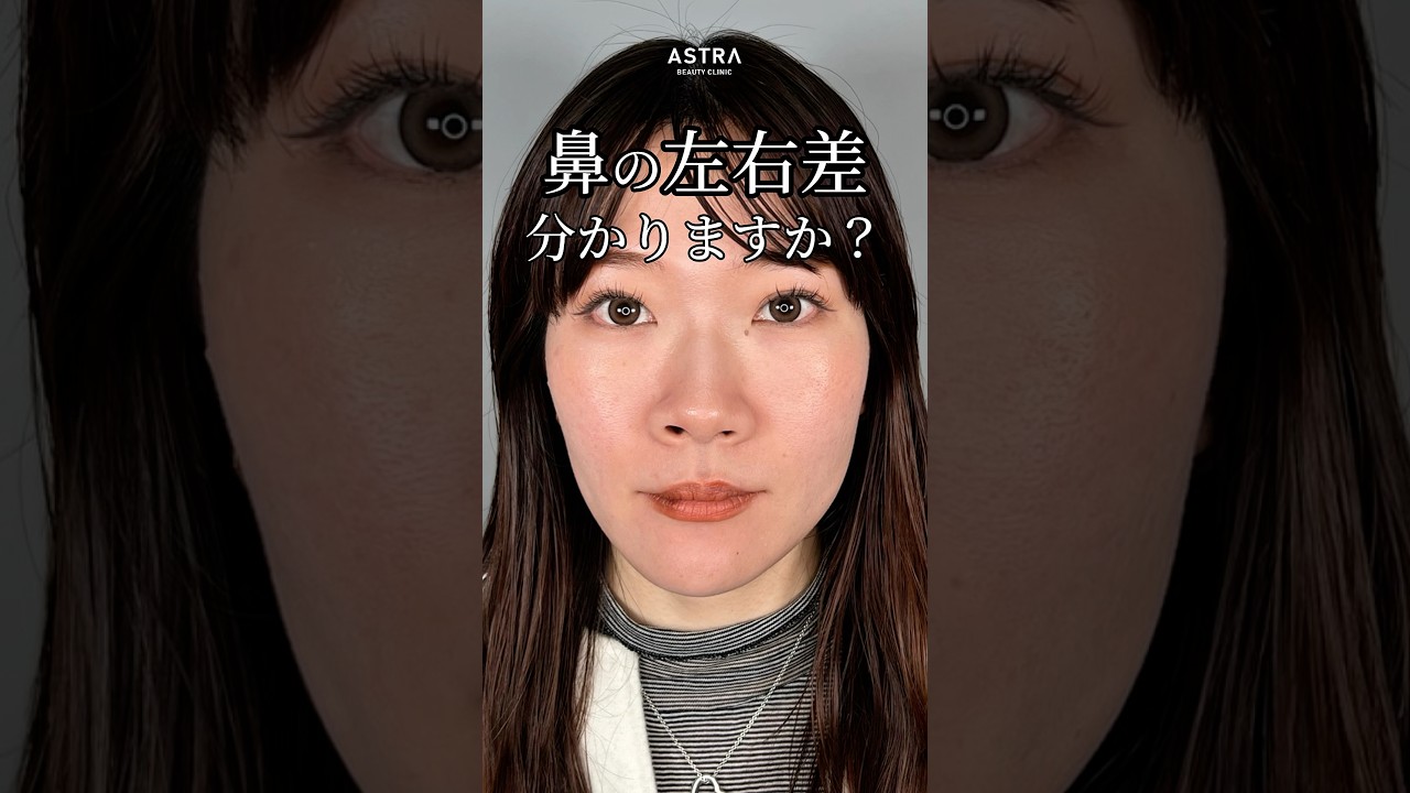 【鼻の左右差を整え、洗練されたお顔の印象へ✨#忘れ鼻#鼻整形#塩満恵子#astrabeautyclinic】