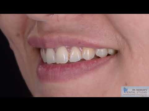 Aligners
