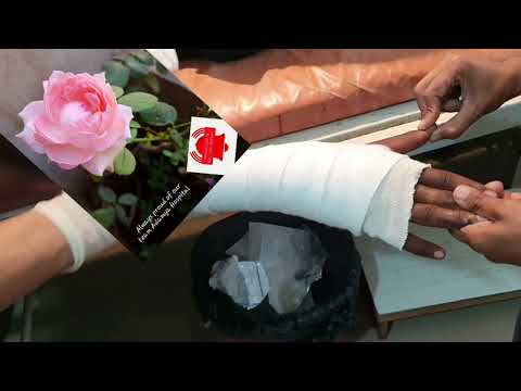 Closed reduction | Inferior Radio-ulnar joint Dissociation Fiberglass plastering | Adamya Hosp video