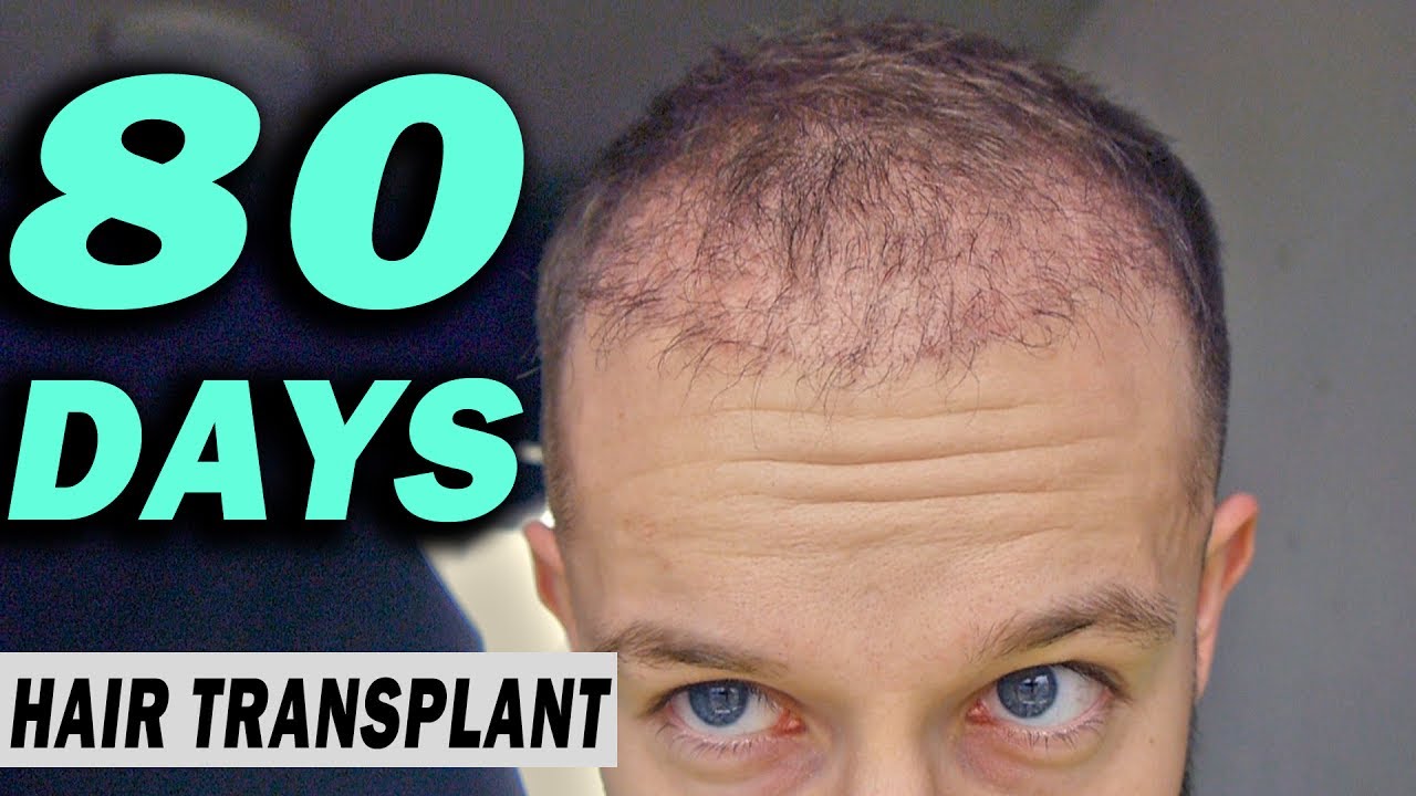 Watch video FUE Hair Transplant 80 DAYS (post op) Istanbul, Turkey GROWTH STAGE Now FUE Hair Transplant 80 DAYS (post op) Istanbul, Turkey GROWTH STAGE