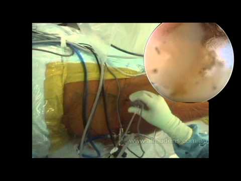 Hip Arthroscopy Part 1