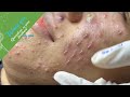 (Acne Treatment for Ha Part 2) - Make Your Day Relaxing with Windy Spa 6#212