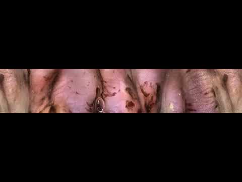 paraziták az emberi vérben a székletben és a hpv vírus