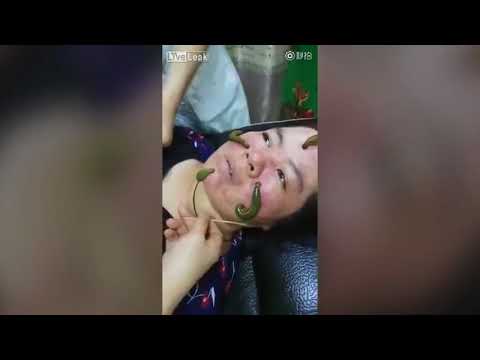 ตัวแทนของกลาก Dermazor โรคสะเก็ดเงิน