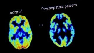 The Brain of a Murderer - Are You Good Or Evil? - Horizon - BBC